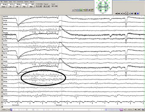 wicket spikes eeg.